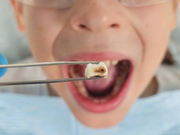 Best Knocked-Out Tooth (Avulsed Tooth) Treatment in Ball Pond, CT
